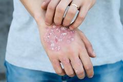 Είναι μεταδοτική η ψωρίαση; Ποια είναι η κατάλληλη διατροφή για τους πάσχοντες;