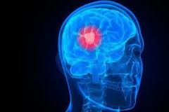 Καρκίνος στον εγκέφαλο: Τα πρώιμα σημάδια