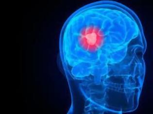 Φωτογραφία για Καρκίνος στον εγκέφαλο: Τα πρώιμα σημάδια