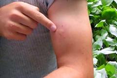 Σας τσίμπησε Σκορπιός, Σφήκα, Μέλισσα, Φίδι; Δείτε τι πρέπει να κάνετε