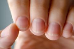 Τα πέντε προβλήματα υγείας που μπορούν να εκδηλωθούν στα νύχια