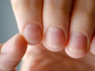 Φωτογραφία για Τα πέντε προβλήματα υγείας που μπορούν να εκδηλωθούν στα νύχια