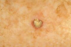 Ακτινική κεράτωση, προκαρκινική βλάβη του δέρματος. Πώς αναπτύσσεται και πώς θεραπεύεται;