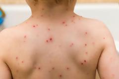 Σε έξαρση η ιλαρά: 34.000 κρούσματα παγκοσμίως το 2019