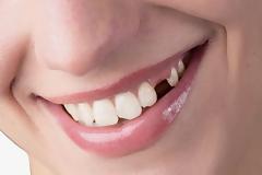 Γιατί χάνεται ένα δόντι; Απώλεια δοντιού, αιτία, συνέπειες, πρόληψη, αντιμετώπιση