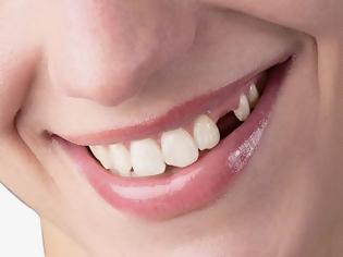 Φωτογραφία για Γιατί χάνεται ένα δόντι; Απώλεια δοντιού, αιτία, συνέπειες, πρόληψη, αντιμετώπιση