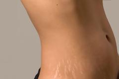 Ραγάδες στο δέρμα: Πώς δημιουργούνται;