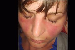 Συστηματικός Ερυθηματώδης Λύκος με εξάνθημα στο πρόσωπο, συνεχή πυρετό, πόνο στις αρθρώσεις, κόπωση