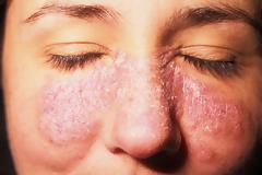 Παγκόσμια Ημέρα για τον Συστηματικό Ερυθηματώδη Λύκο (10 Μαΐου).