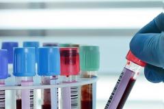 ΙΣΡ: «Η δωρεάν παροχή εξετάσεων μεταβιβάζεται στους εργαστηριακούς ιατρούς μέσω Claw-back»