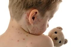 Βαριά πρόστιμα σε γονείς που δεν κάνουν στα παιδιά τους το εμβόλιο της ιλαράς προωθεί η Γερμανία!