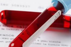 Οχτώ συμπτώματα που δείχνουν ότι ο αιματοκρίτης σας είναι κάτω από τα όρια