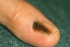 Μελάνωμα σε νύχι, άκρες δακτύλων. Οι σκούρες γραμμές στα νύχια είναι αιμάτωμα ή καρκίνος;