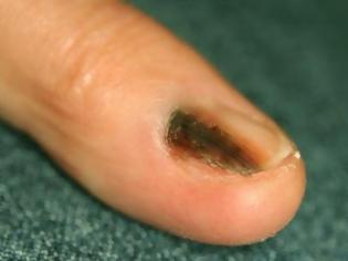 Φωτογραφία για Μελάνωμα σε νύχι, άκρες δακτύλων. Οι σκούρες γραμμές στα νύχια είναι αιμάτωμα ή καρκίνος;