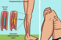 Kρίσιμα σημάδια της κακής κυκλοφορίας του αίματος και των φραγμένων αρτηριών.Δείτε τι πρέπει να κάνετε