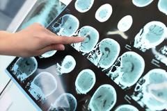 Μνήμη: Ενισχύστε την με τροφές πλούσιες σε βιταμίνη Β12