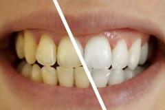 Τι μπορεί να προκαλέσει αλλαγή στο χρώμα των δοντιών μας;