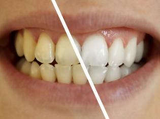 Φωτογραφία για Τι μπορεί να προκαλέσει αλλαγή στο χρώμα των δοντιών μας;