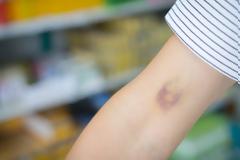 Μελανιές χωρίς λόγο; Τι μπορεί να συμβαίνει;