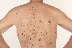 Σμηγματορροϊκή υπερκεράτωση, στο δέρμα. Πόσο επικίνδυνη είναι και πώς αφαιρείται;