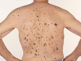 Φωτογραφία για Σμηγματορροϊκή υπερκεράτωση, στο δέρμα. Πόσο επικίνδυνη είναι και πώς αφαιρείται;