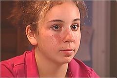 Οζώδης σκλήρυνση. Προκαλεί σπασμούς, επιληπτικές κρίσεις, διαταραχές συμπεριφοράς, αυτισμό, νοητική καθυστέρηση