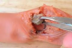 Δείτε τι ζημιά μπορεί να κάνει μια μπαταρία ρολογιού στο χέρι ενός παιδιού!