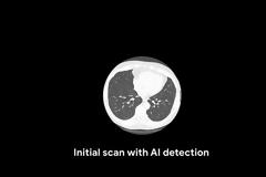 Τεχνητή νοημοσύνη για πρόγνωση του καρκίνου του πνεύμονα