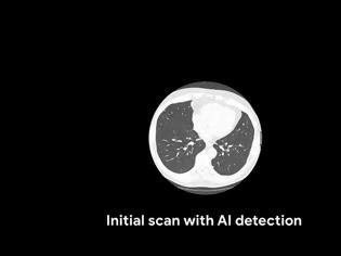 Φωτογραφία για Τεχνητή νοημοσύνη για πρόγνωση του καρκίνου του πνεύμονα