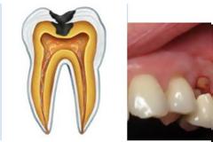 Aπονεύρωση. Πότε είναι απαραίτητη η ενδοδοτική θεραπεία