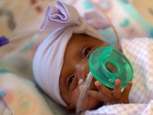 Φωτογραφία για Το θαύμα της ζωής: Κοριτσάκι γεννήθηκε 245 γραμμάρια αλλά κέρδισε τη μάχη μετά από πέντε μήνες