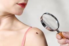 ΞΕΚΙΝΑ η Εβδομάδα δωρεάν ελέγχου για τον Καρκίνο του Δέρματος, 3 - 7 Ιουνίου (video)