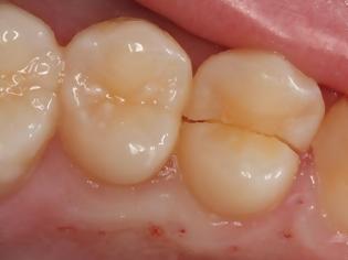 Φωτογραφία για Kάταγμα δοντιού με πόνο στο δάγκωμα. Μήπως έχει σπάσει δόντι;
