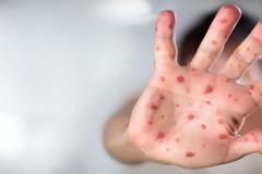 Στα πρόθυρα επιδημίας ιλαράς οι ΗΠΑ!