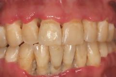 Έντονη κακοσμία, μεταλλική γεύση, αιμορραγία ούλων μπορεί να οφείλονται σε οξεία ελκονεκρωτική ουλίτιδα