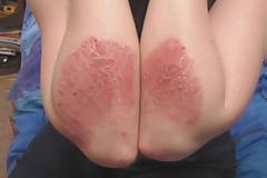 Υπάρχουν λύσεις για τους ασθενείς με ψωρίαση. Βγείτε από το σπίτι