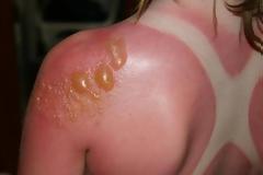 Τι είναι το ηλιακό έγκαυμα και τι προκαλεί; Πρώτες βοήθειες