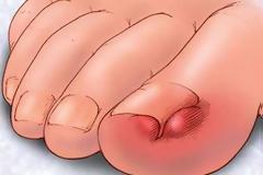 Νύχι που μπαίνει στο δέρμα: Τι μπορείτε να κάνετε στο σπίτι