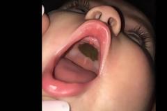 Είδε αυτό το σημάδι στο στόμα του μωρού της και πανικοβλήθηκε