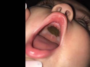 Φωτογραφία για Είδε αυτό το σημάδι στο στόμα του μωρού της και πανικοβλήθηκε