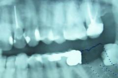 Ένα δόντι μεγάλωνε γεννητικά όργανα