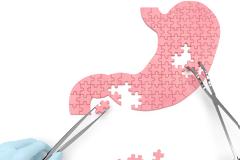 Η τεχνική που δίνει οριστική λύση στην παχυσαρκία