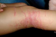 Σας τσίμπησε μέδουσα, τσούχτρα; Διαβάστε τι πρέπει να κάνετε