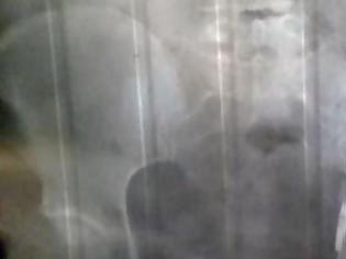 Φωτογραφία για Μία 62χρονη είχε για 23 χρόνια ξεχασμένο στην κοιλιά της ένα χειρουργικό ψαλίδι