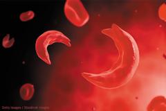 Δρεπανοκυτταρική και Μικροδρεπανοκυτταρική Αναιμία