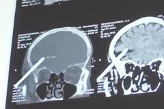 Κάρφωσε δύο καρφιά στο κεφάλι του για να αυτοκτονήσει αλλά επέζησε!