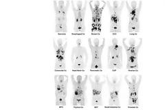 Η εξέταση που εντοπίζει 30 διαφορετικούς καρκίνους