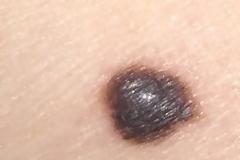 Εξαιρετικά τα αποτελέσματα του συνδυασμού nivolumab ipilimumab στο μεταστατικό μελάνωμα