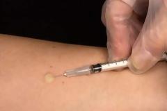 Ολα όσα πρέπει να γνωρίζετε για τη φυματίωση -Πώς κολλάει, ποιοι κινδυνεύουν