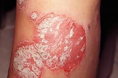 Αποτελέσματα Μελέτης: H απρεμιλάστη είναι εξαιρετικά αποτελεσματική στην Ψωρίαση